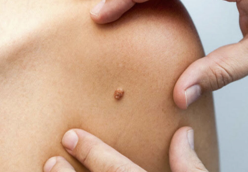 Peran Nutrisi dan Gaya Hidup dalam Melawan Papiloma dan Parasite